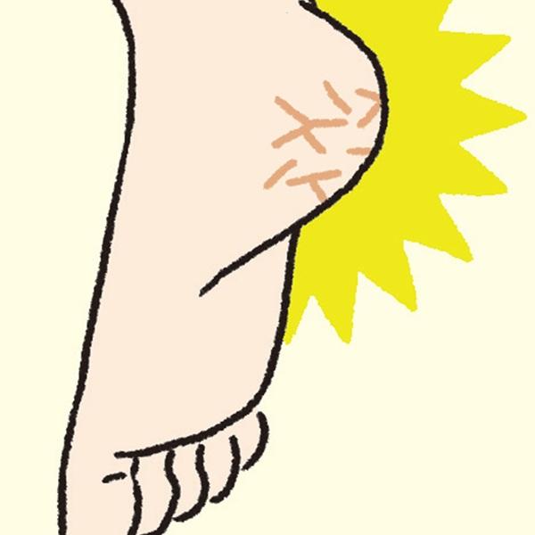 サンダル履きで目立つ、ひび割れたかかと…“かかとのガサガサ”原因&対策